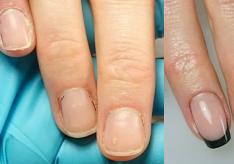 Способы восстановления ногтей после процедуры наращивания