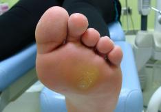 Calos desagradáveis ​​nos pés: tratamento e alívio rápido em casa